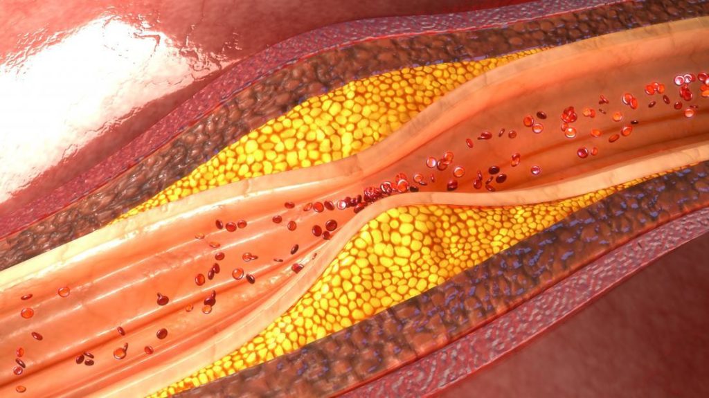 Cardiovascular Disease